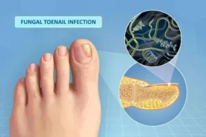 Toenail fungus infection showing yellow discolored nail and microscopic view of fungal biofilm growth under the nail